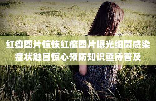 红癣图片惊悚红癣图片曝光细菌感染症状触目惊心预防知识亟待普及